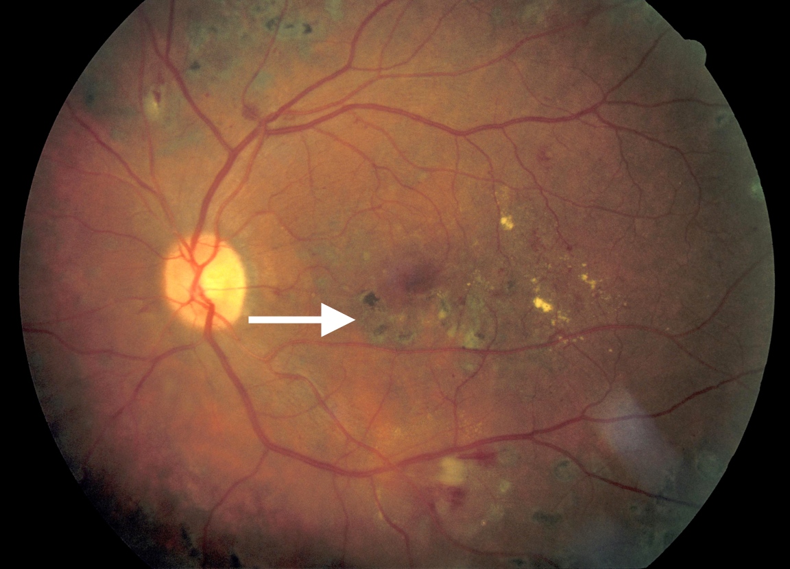 diabetesmanager / Diabetic Retinopathy